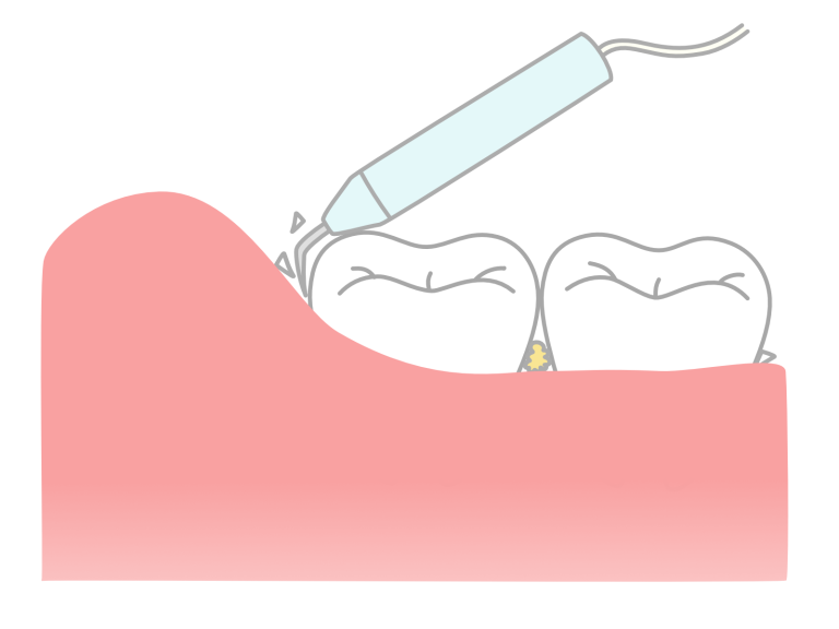 歯医者で歯石取り（歯石除去）を行う事をおすすめします