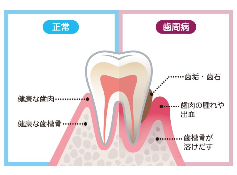 歯周病の原因