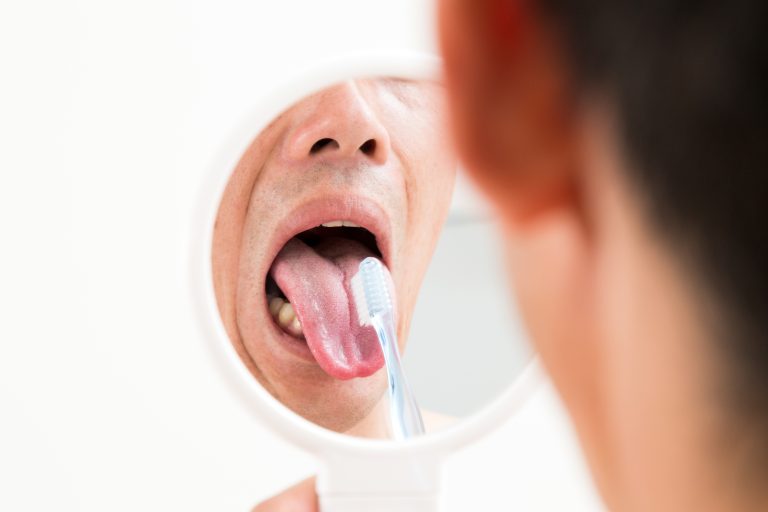 舌の汚れ（舌苔：ぜったい）や歯周病