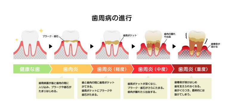 歯周病ってどのような病気なの？