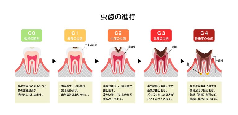 虫歯の進行は1ヶ月ぐらいで進行するものなの？